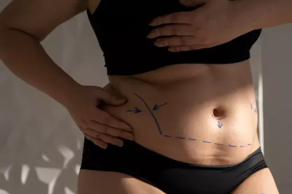 Liposuction