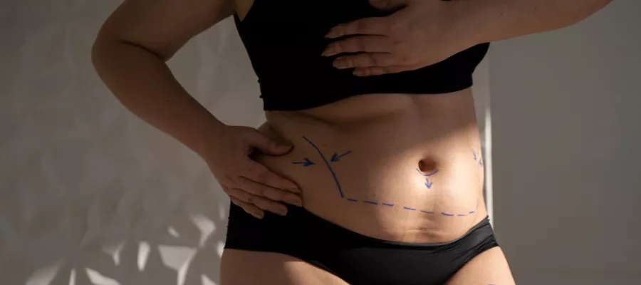 Liposuction